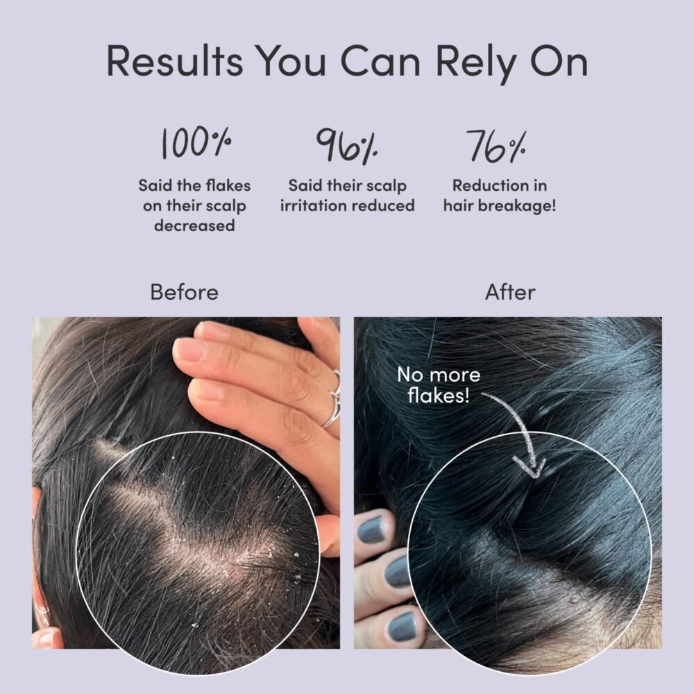 مجموعة الشامبو والبلسم والسيروم ضد القشرة من جوبتر - للعناية بفروة الرأس الجافة، الحكة، الدهنية، والقشرية (خالية من الكبريتات) - الصورة 2