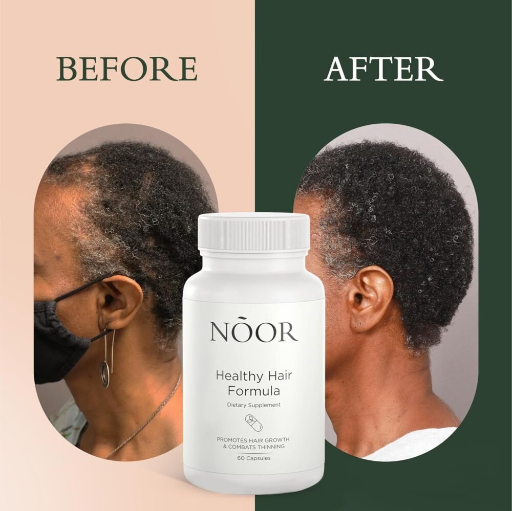 سيروم نوور لنمو الشعر ومكمل غذائي لعلاج تساقط الشعر للنساء - علاج للشعر التالف - الصورة 5