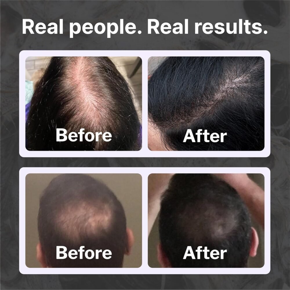 مجموعة Shapiro MD للعناية بالشعر الطبيعي للحصول على شعر أكثر كثافة وكثافة وصحة - شامبو وبلسم وفوم يومي (إمداد شهري) - الصورة 5