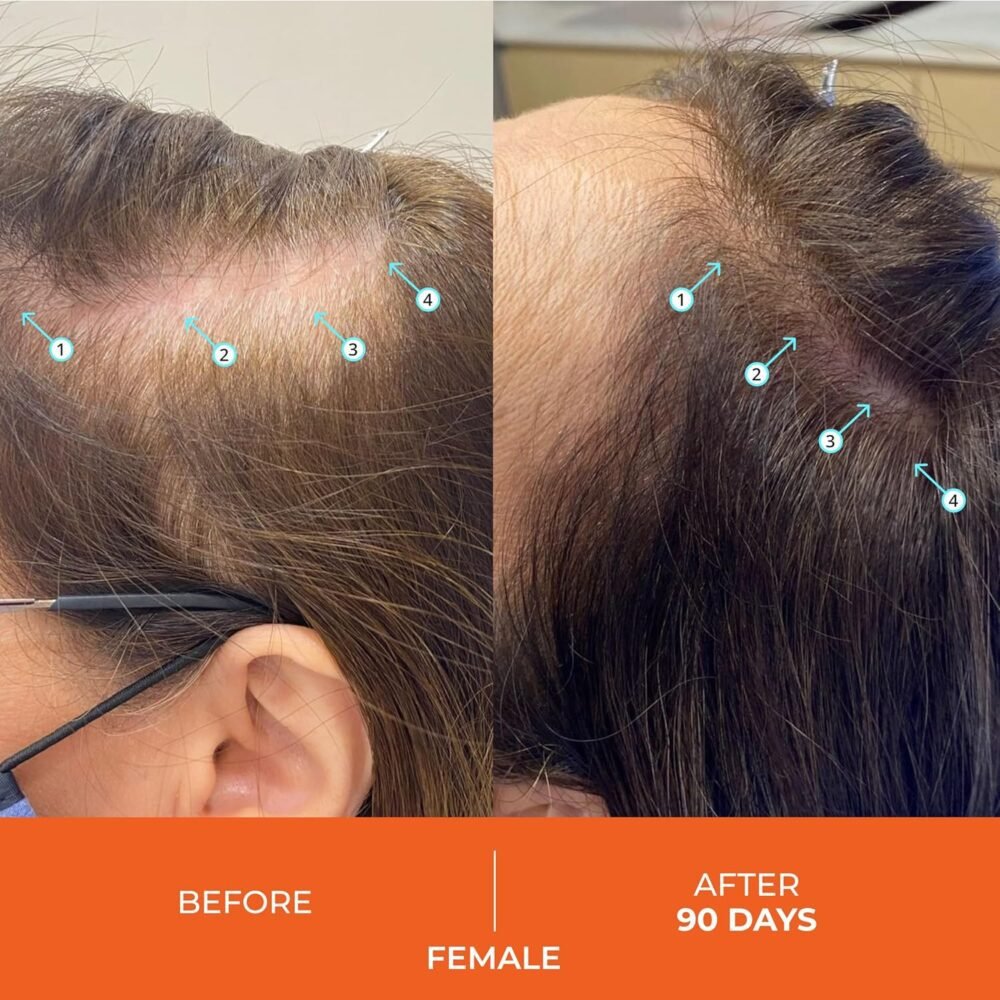 مجموعة شامبو وبلسم Revita من DS Laboratories - شامبو وبلسم لنمو الشعر، شامبو وبلسم لتكثيف الشعر للنساء والرجال، مع علاج منع DHT لمكافحة تساقط الشعر - الصورة 4